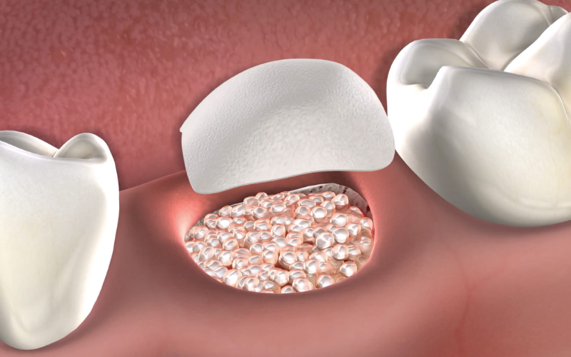 Connection Between Osteoporosis and Bone Grafting